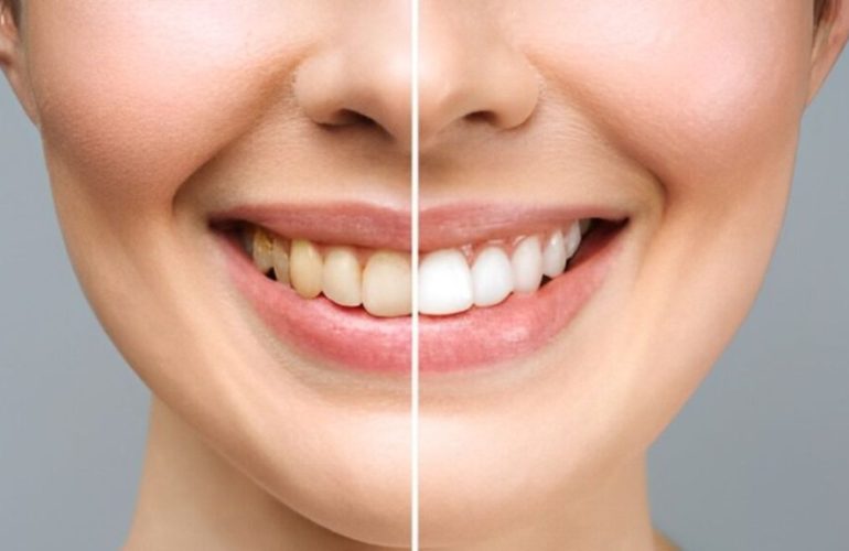 clareamento-dental